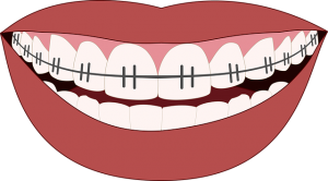 nadwrażliwość zębów